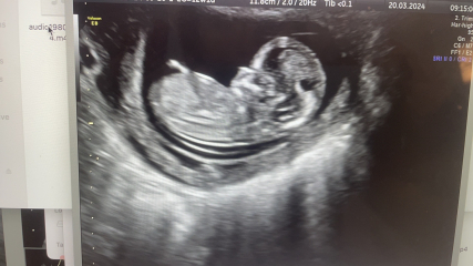 12 week scan- BOY or GIRL?! Nub theory!