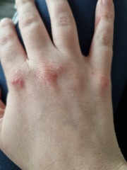 Bumps/blisters on hands