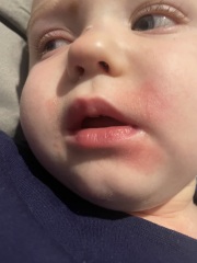 Toddler has fever !