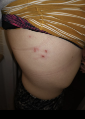 Shingles?