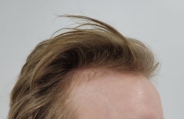 I’ve just had a hair transplant AMA