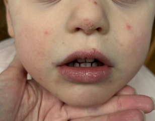 Is this chicken pox?