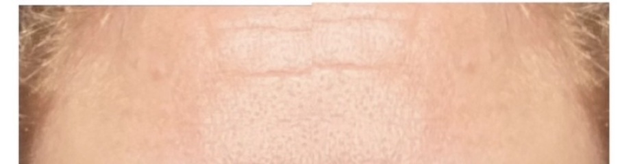 Reduce Wrinkles or Frown Lines