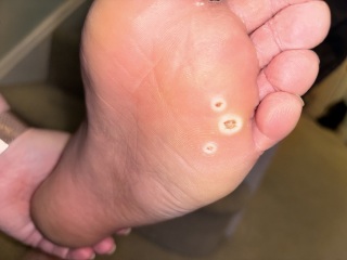 Foot ulcer? **WARNING PHOTO**
