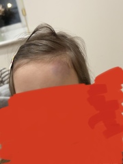 4 Year Old head bump Wednesday. Still swollen today.