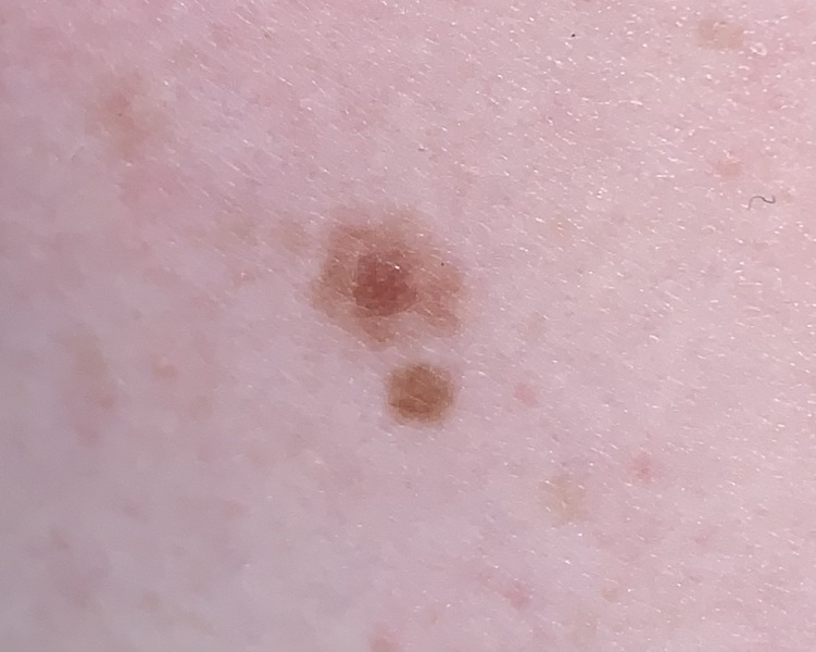 Is this mole abnormal looking