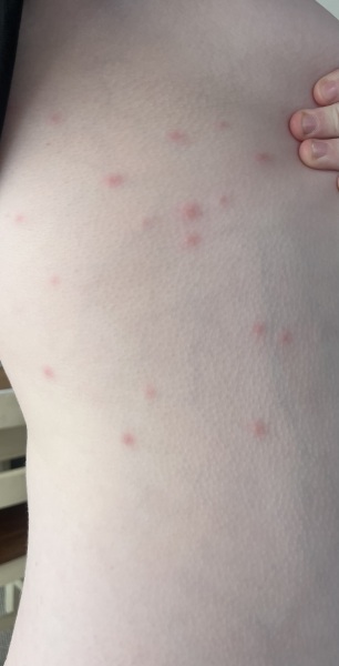 If this isn’t chicken pox, any ideas what it is?