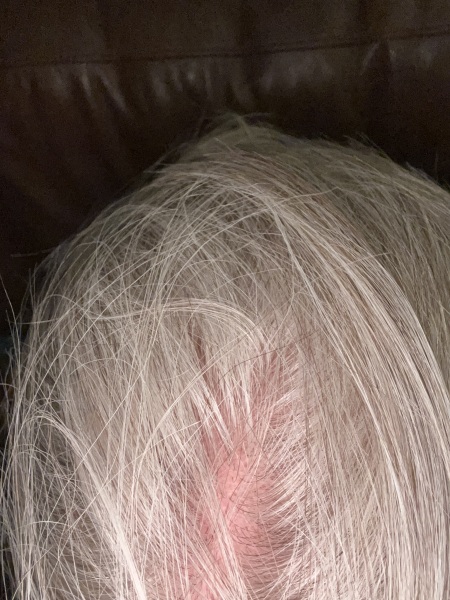 Flaky, scaly scalp.