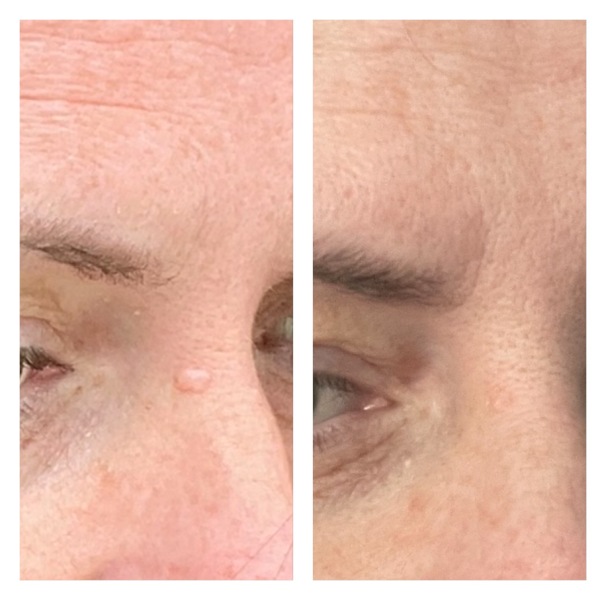 Glycolic mask…wart disappearing?