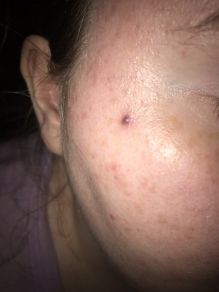Unusual spot on face with photos