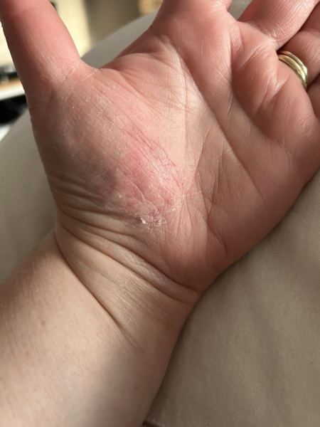 Is this eczema on my hand? -Pic warning!