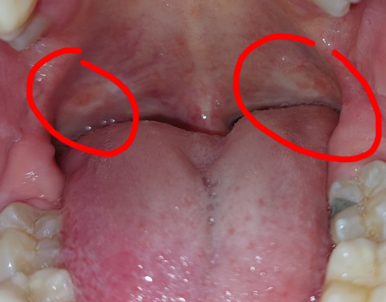 Weird spot things in my mouth