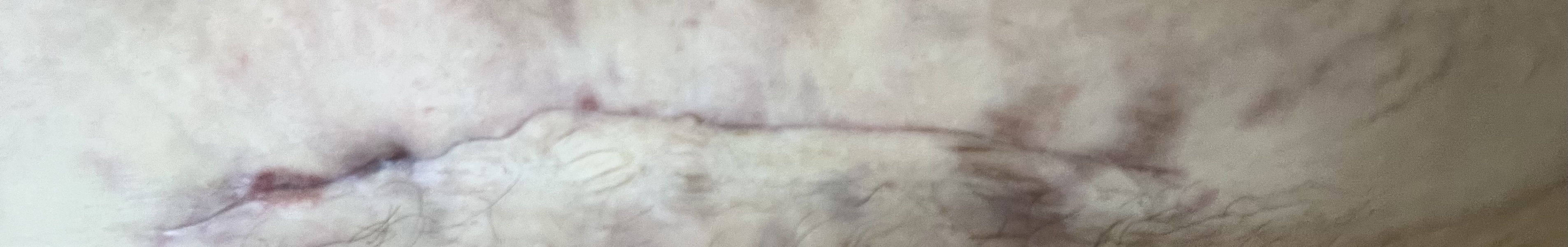 Infection CS incision