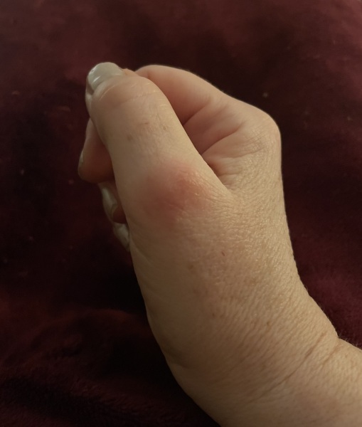 What is this? Chilblain? Excema?