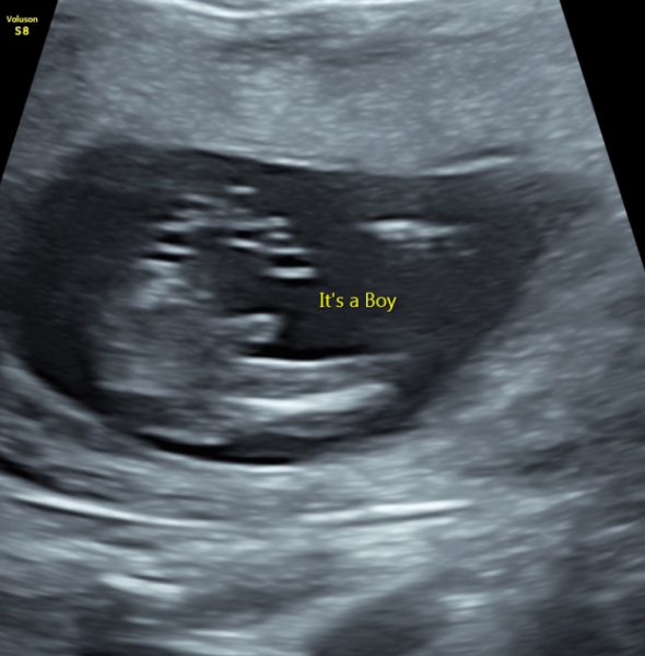 15 week scan help?