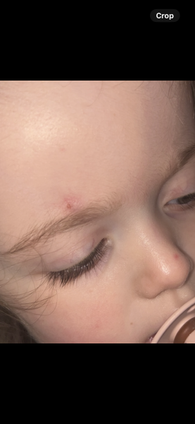 Lump on toddler eyebrow