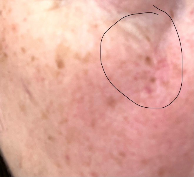 Facial oil/ moisturiser to minimise scarring after treatment