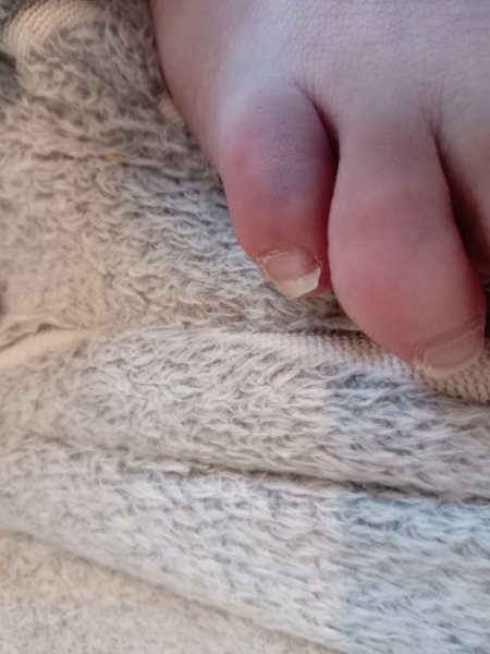 Bruised toe