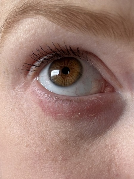 Dry skin under eyes, help!