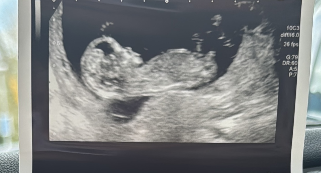 12 weeks scan girl or boy