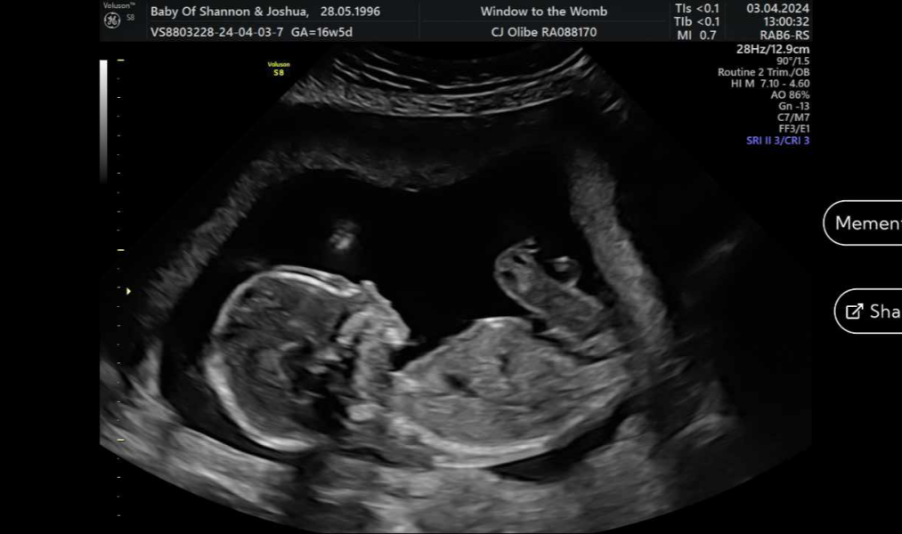 1:90 Chance My Child Could Have Downsydrome.