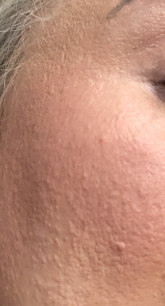 Any skin experts who can tell me what this is, on my face?