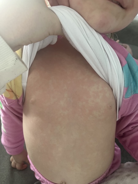 Does anyone know what this rash is?