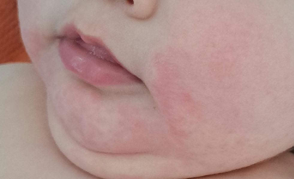 Res spots on baby's face