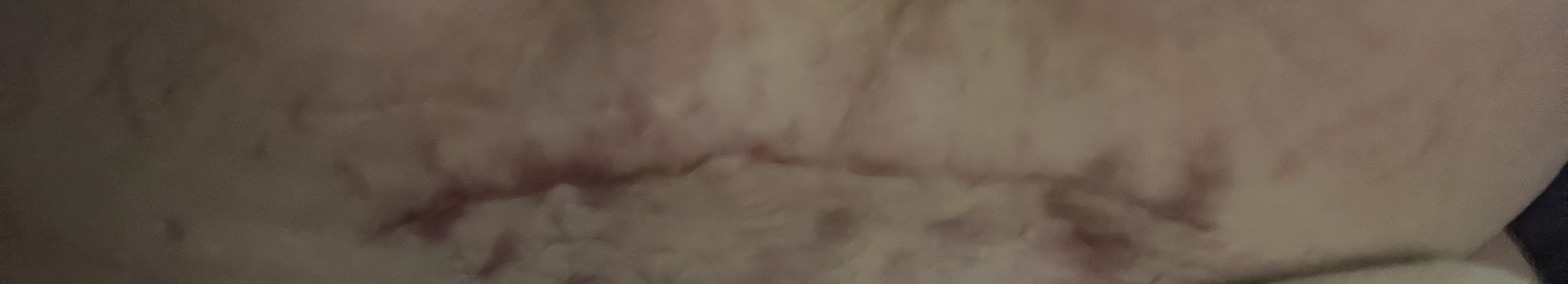 C Section Scar - struggling to heal