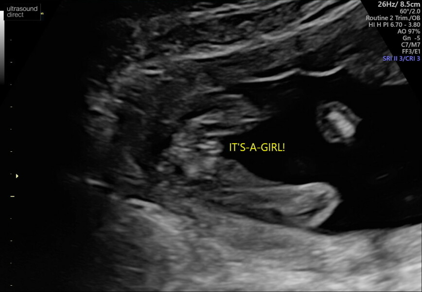 Gender confirmation