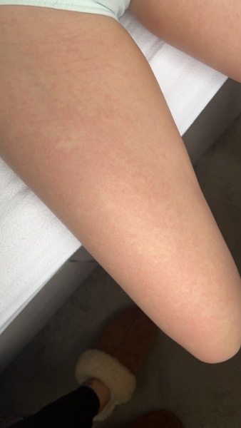 Help me figure out this rash…