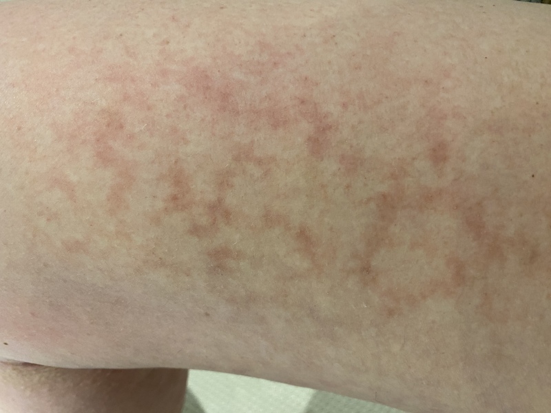 Should I be worried about this mark …? (Pic)
