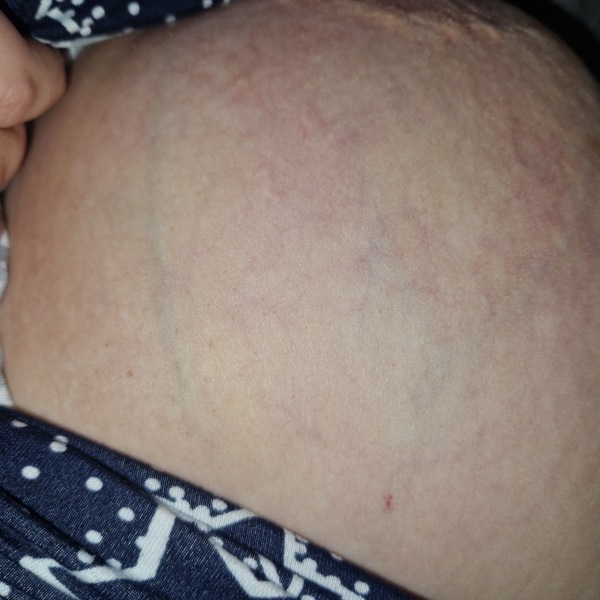 To ask about veins