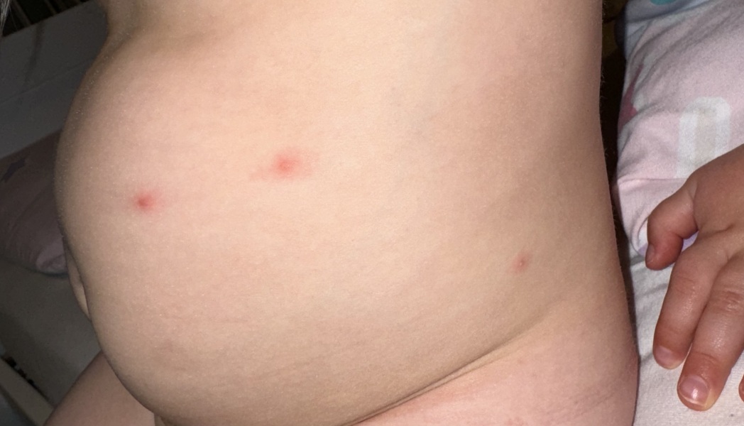 Spots on child