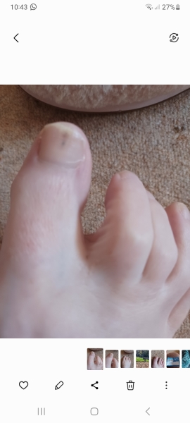 Worrying mark on toe