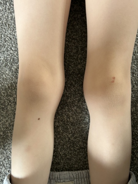5yo knees