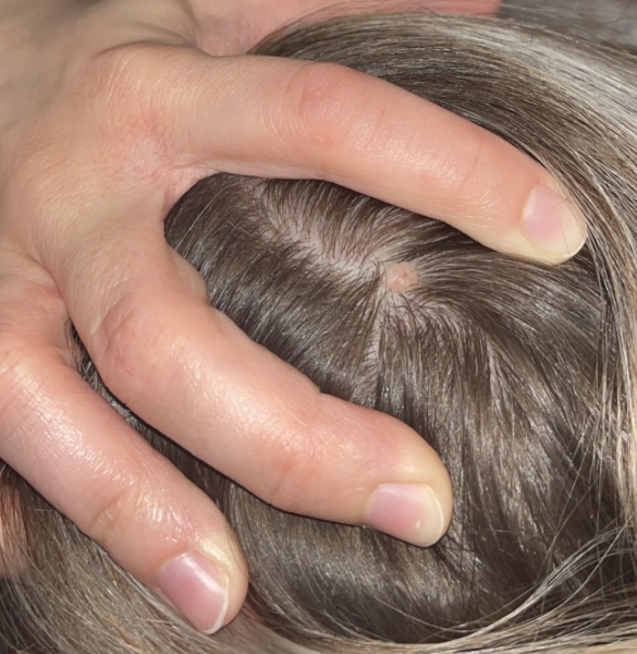Growth on scalp?
