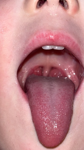 tonscillectomy and adenoidectomy