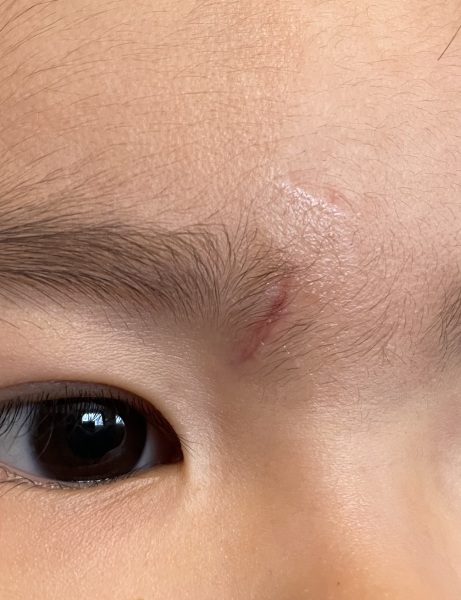 Help! Scar on my LO's face
