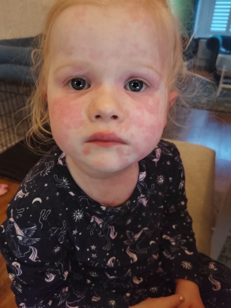 MMR RASH