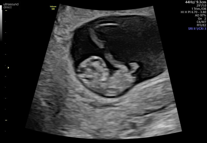 TTC after chemical - anyone with me?