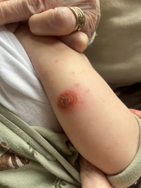 What is this scab? Is it a bite?