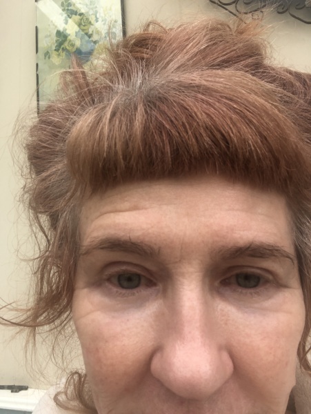 Anyone had upper eyelid surgery?