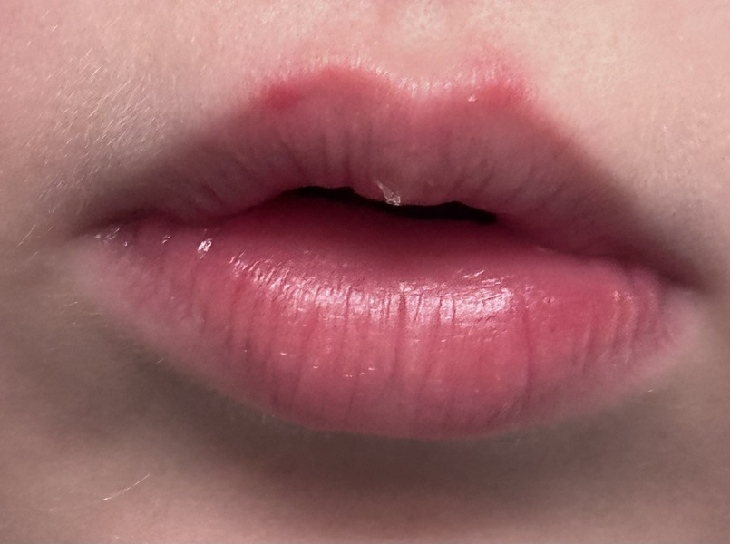 Does this look like a cold sore?