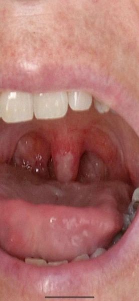 Strep throat? White uvula & other symptoms **TW photo
