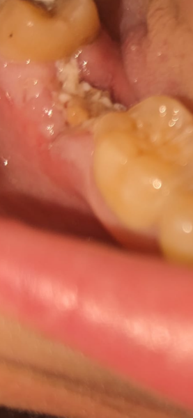 Dry Socket? Normal? Mind is blown!