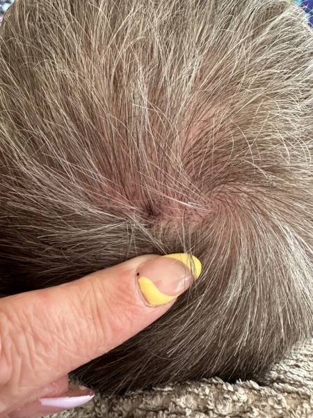 Anyone au fait with suspicious moles? Photos attached
