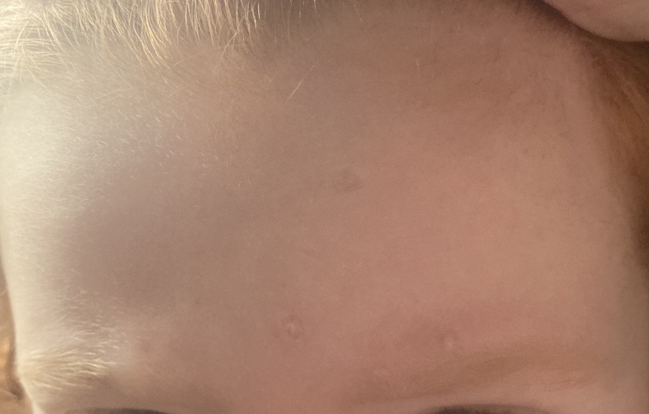 Chicken pox pock marks- the after scars! 