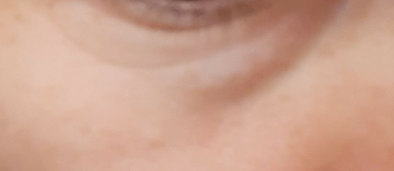 To think these aren't normal wrinkles for a 32 year old?