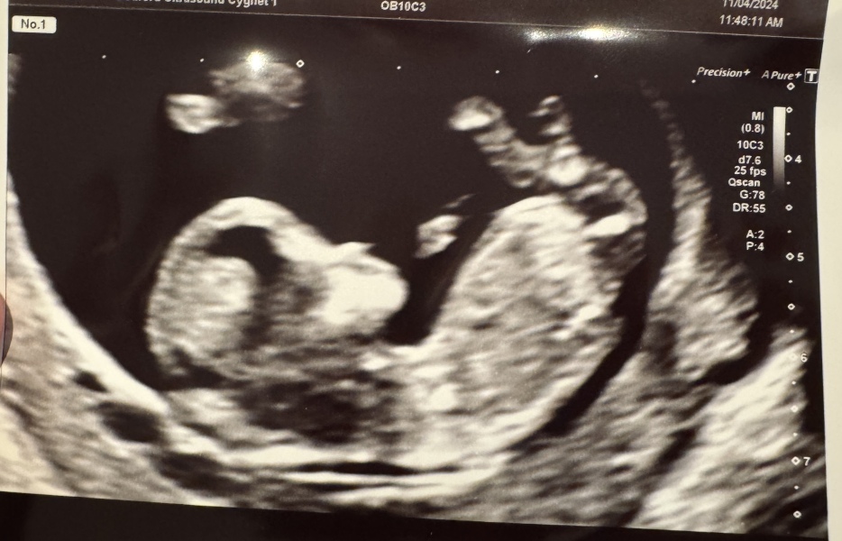 Do you want me to guess the sex? 12 week scans.